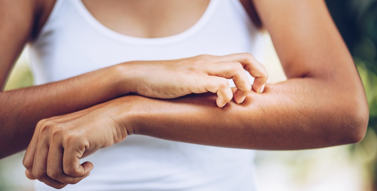 I DIVERSI TIPI DI ECZEMA