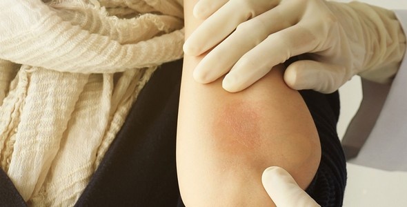 est-ce bien de l'eczema