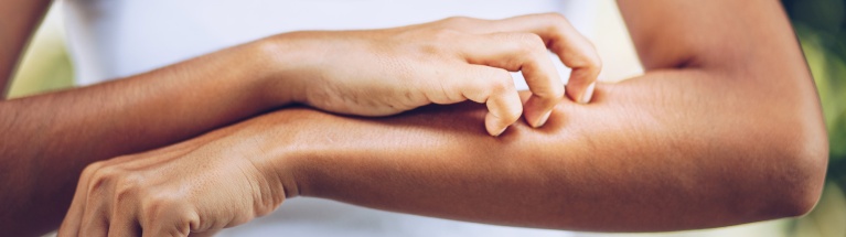 Types d'eczéma
